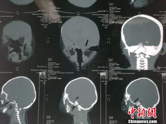 美国路易斯安那理工大学发生持刀伤人事件 至少4人受伤